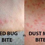 Dust Mite Bites Vs Bed Bug Bites 2021