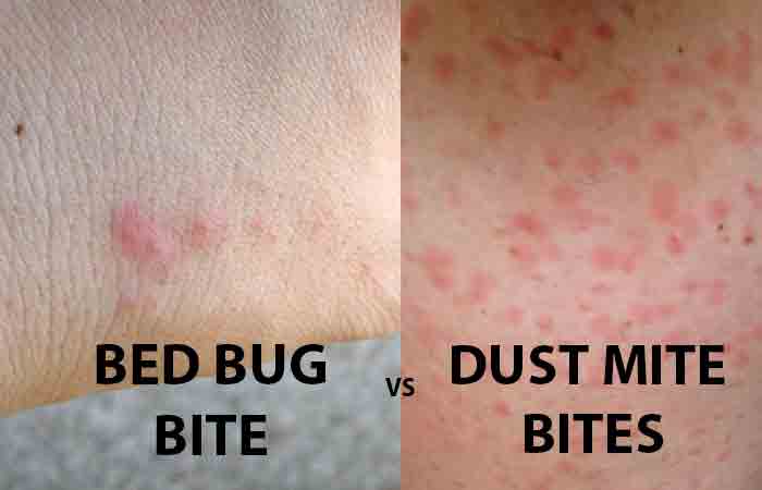 Dust Mite Bites Vs Bed Bug Bites 2021
