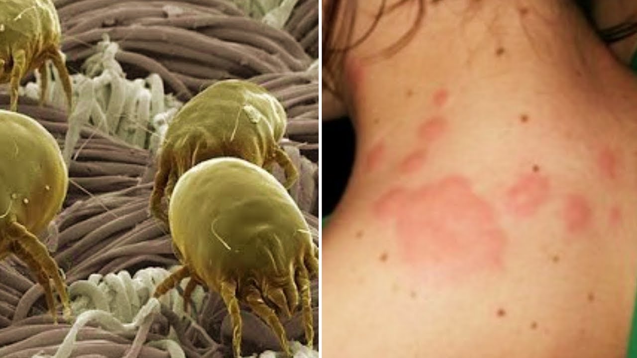 Signs of Dust Mites and Scabies